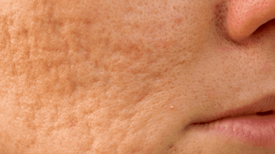 Apa Itu Ice Pick Scars? Ini Penyebab dan Cara Menghilangkannya