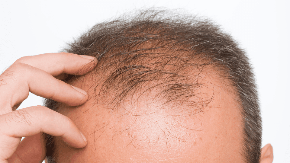 cara mengatasi telogen effluvium