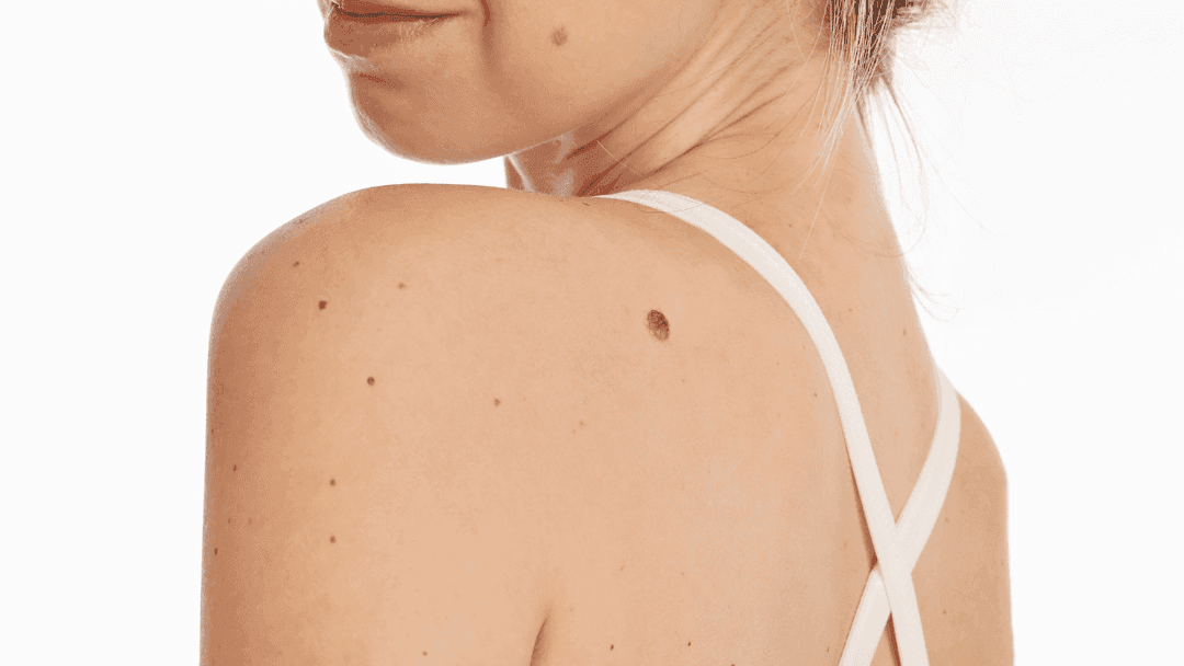 cara menghilangkan skin tag