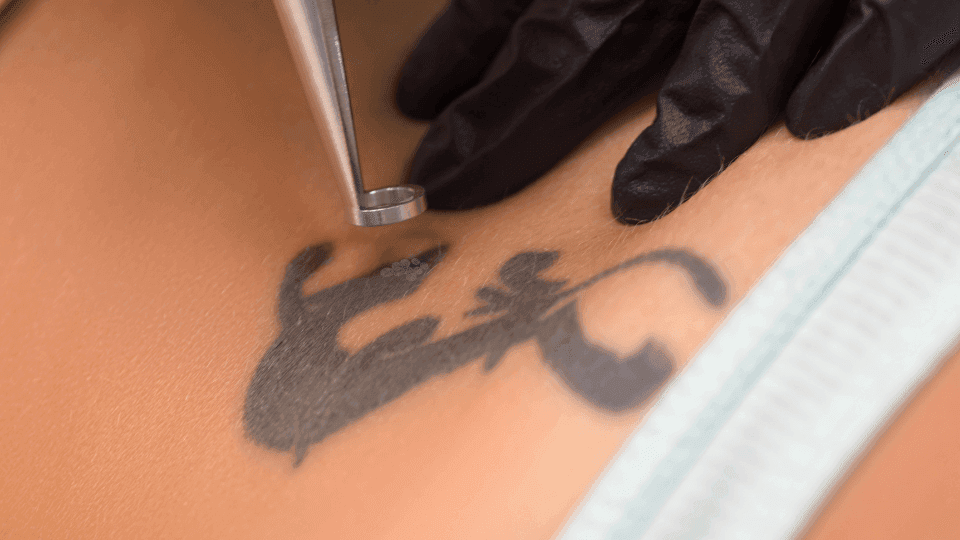 Tatto Removal: Jenis, Prosedur, Resiko & Cara Perawatannya