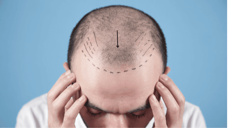 Mengenal Prosedur Transplantasi Rambut dan Efek Sampingnya