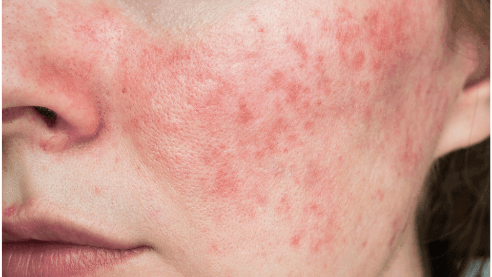 Ciri-Ciri Wajah yang Terkena Merkuri dan Cara Mengatasinya