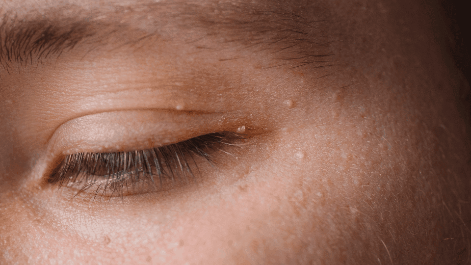 Pengertian Cauter Milia, Prosedur, dan Perawatan Pasca Cauter