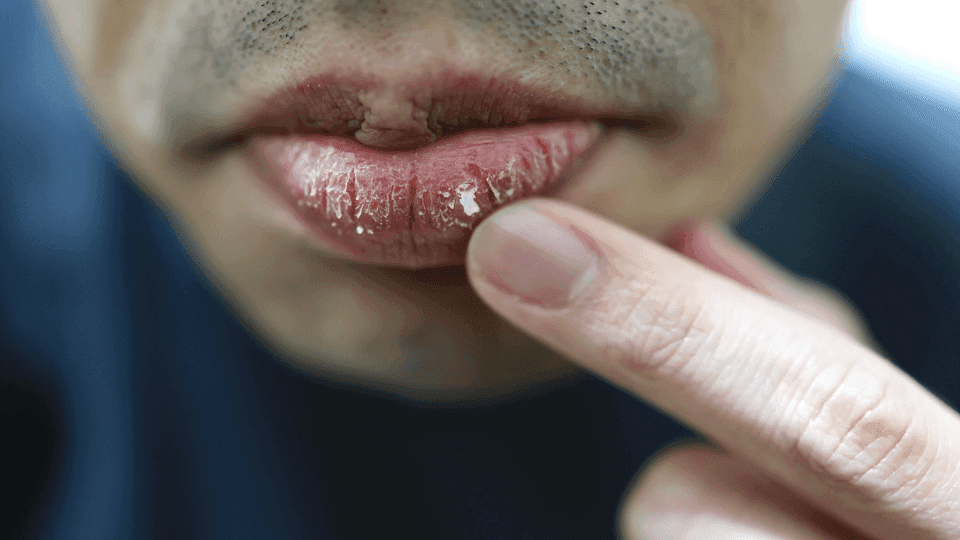 Kenapa Bibir Pecah-Pecah Saat Puasa? Cek Kebiasaan Burukmu di Sini