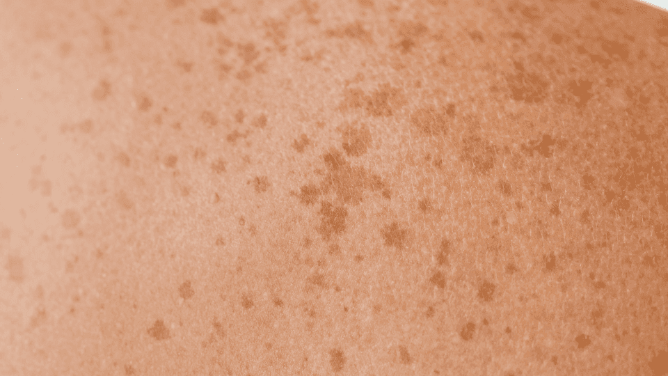 Apa Itu Lentigo? Ini Gejala, Penyebab dan Cara Mengatasinya