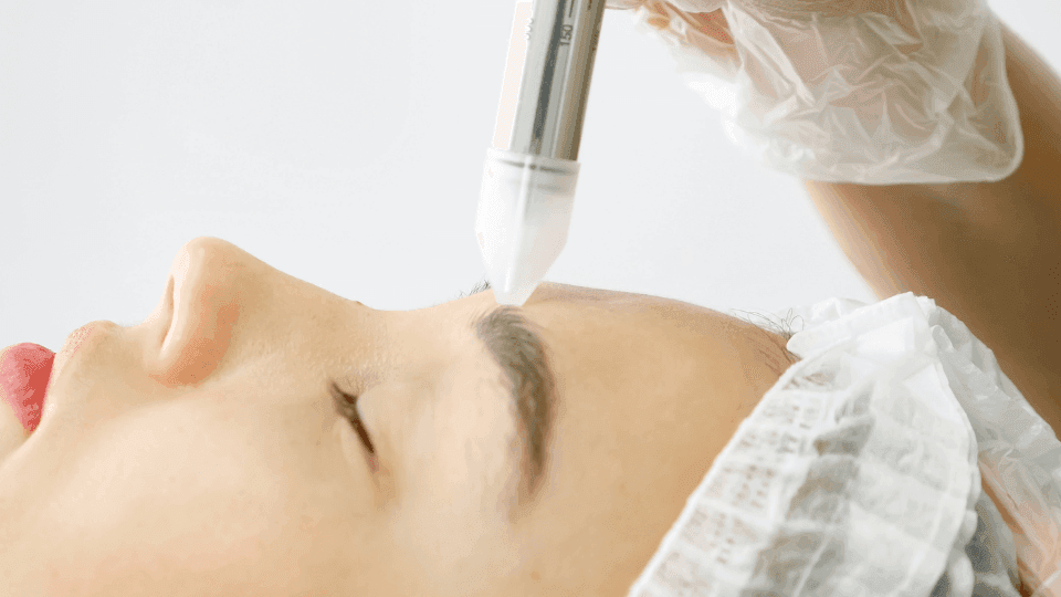 Microdermabrasion vs Chemical Peeling: Mana yang Lebih Baik?
