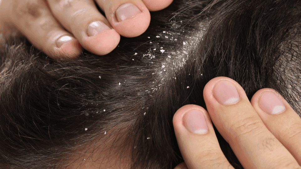 7 Penyebab Ketombe Berkerak dan Cara Mengatasinya