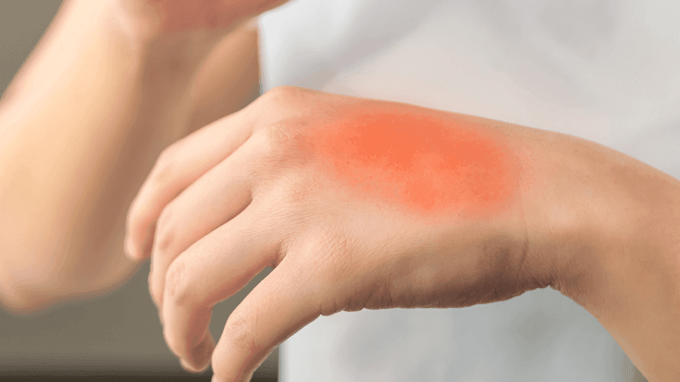 menyembuhkan luka bakar knalpot