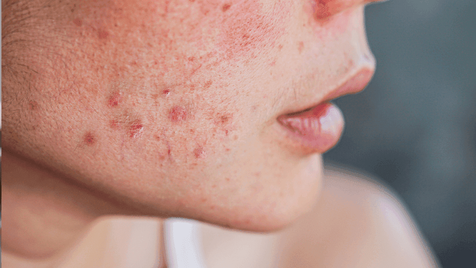 Ciri alergi kosmetik