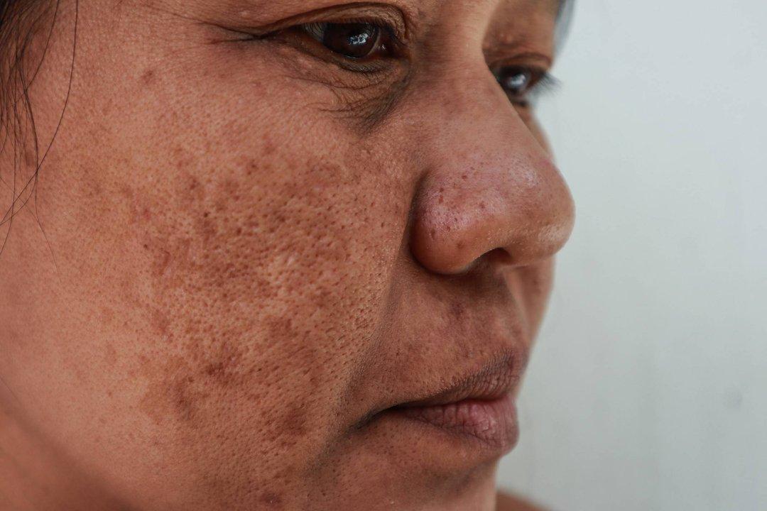 artikel flek noda hitam wajah melasma diricare.com