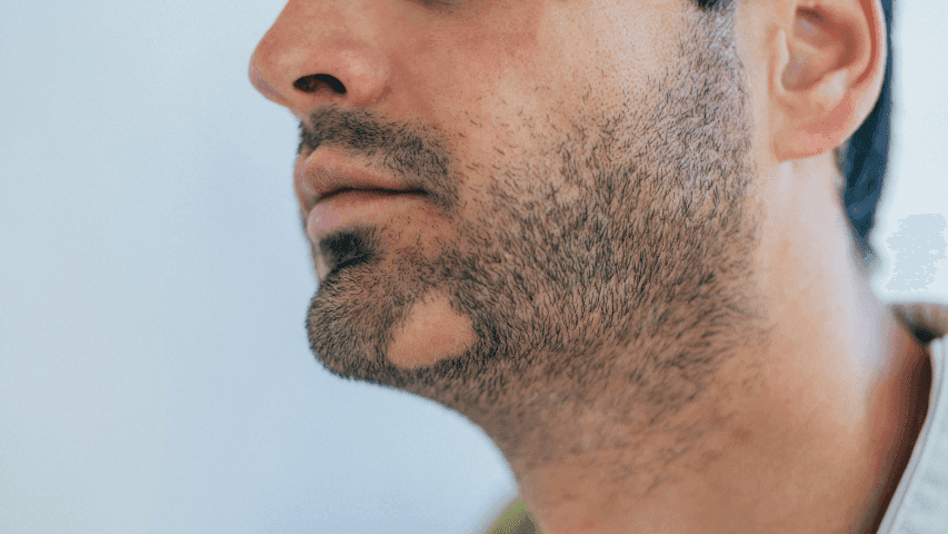 Atasi brewok tidak rata Diricare