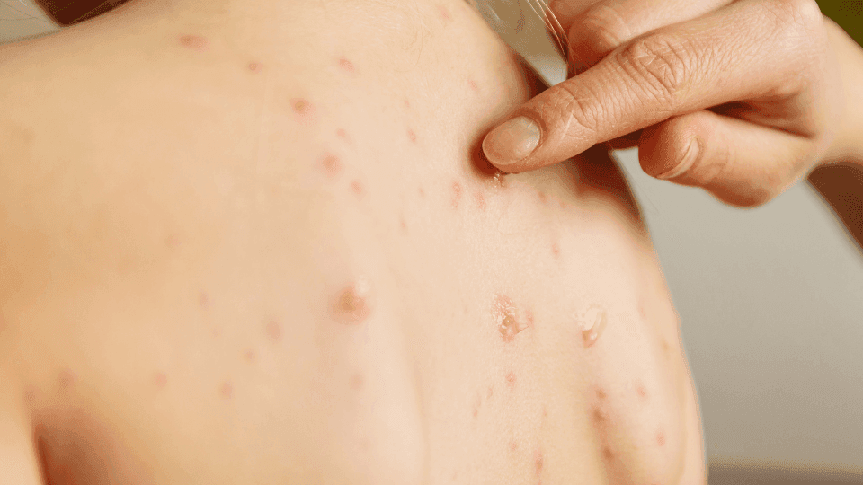 cara mencegah jumlah cacar air