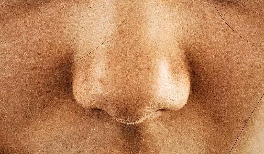 Cara Menghilangkan Komedo Hitam di Hidung Diricare