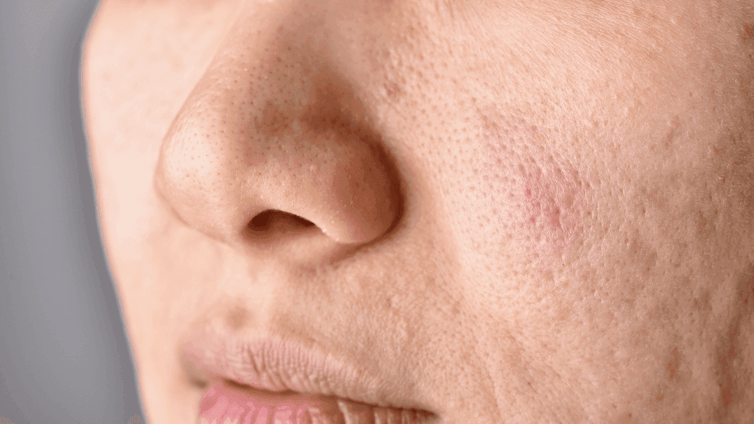 menghilangkan pori pori wajah