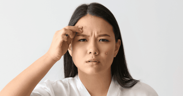 Jerawat Batu hilang secara Alami diricare