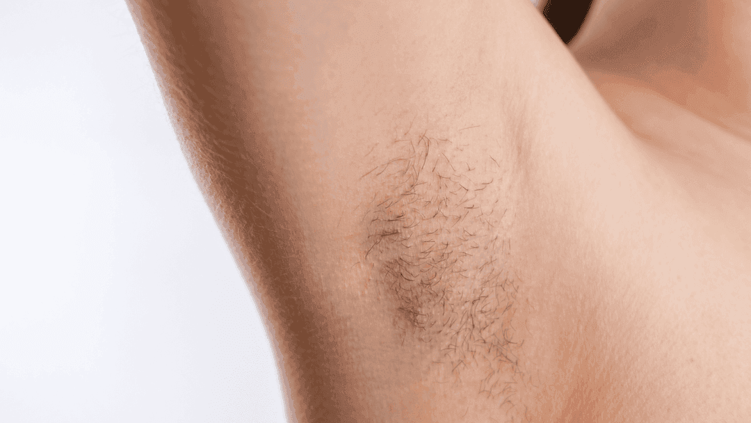 cara menghilangkan rambut ketiak