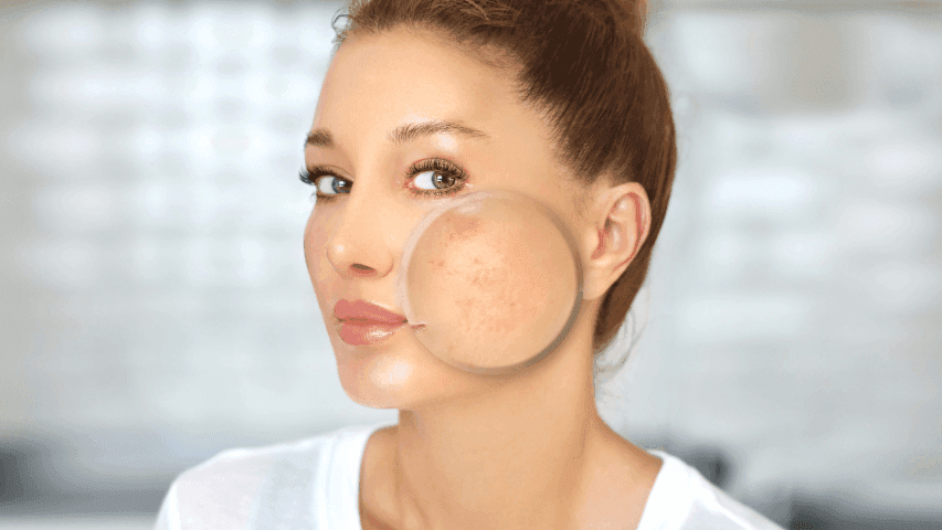 Perbedaan Fungal Acne dan Bruntusan Diricare