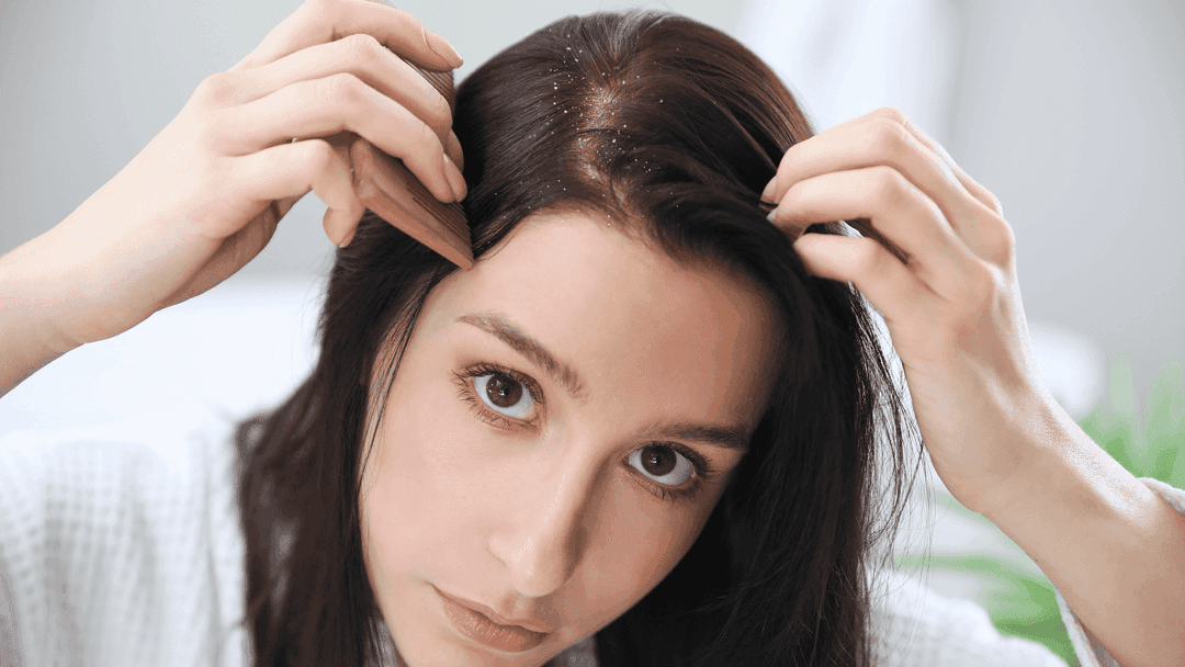 beda ketombe dan dermatitis seboroik