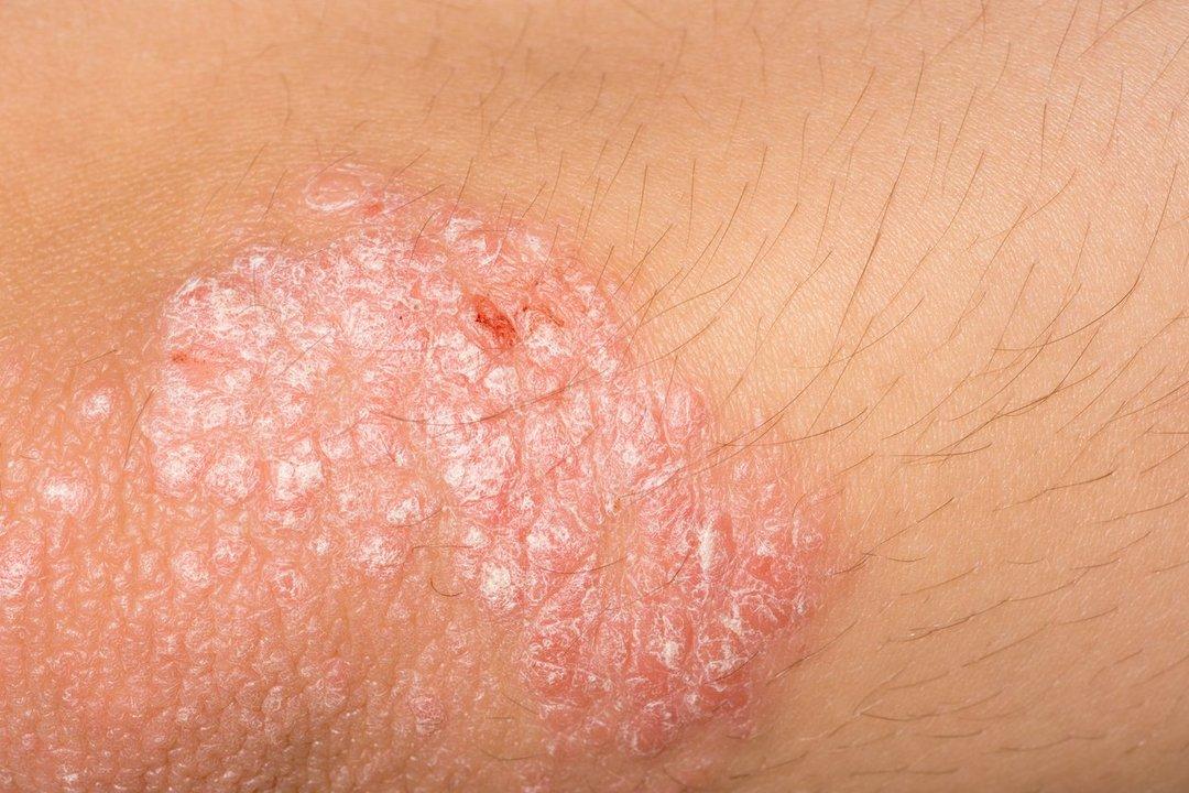 Fakta dan Cara Mengobati Psoriasis Diricare