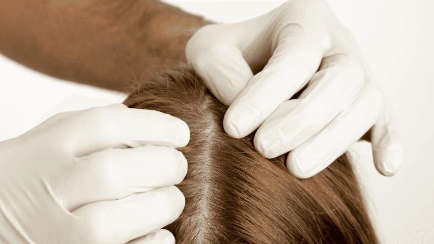 Atasi Infeksi Jamur Kulit Kepala Diricare