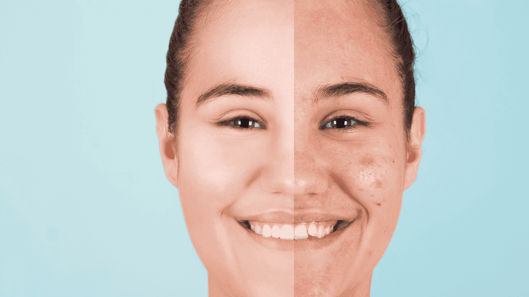 peeling acne untuk menghilangkan jerawat