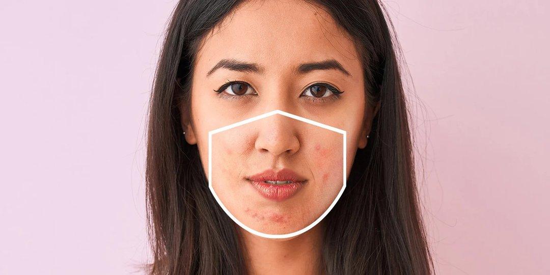 Cara Mencegah Maskne Diricare