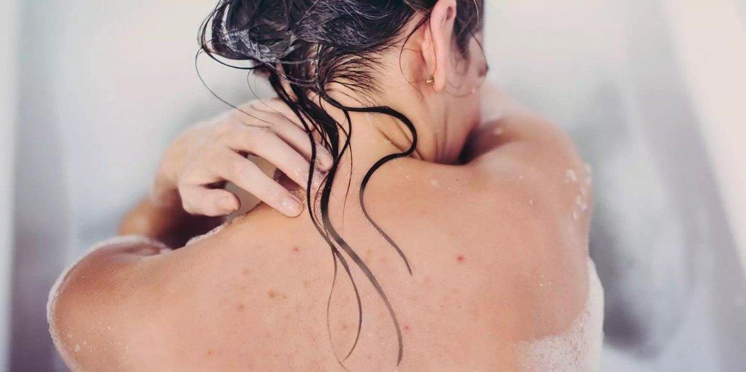 Cara Menghilangkan Jerawat Punggung Diricare