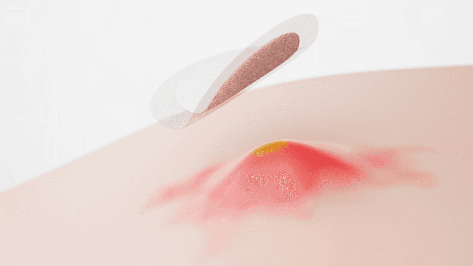 Cara menggunakan acne patch