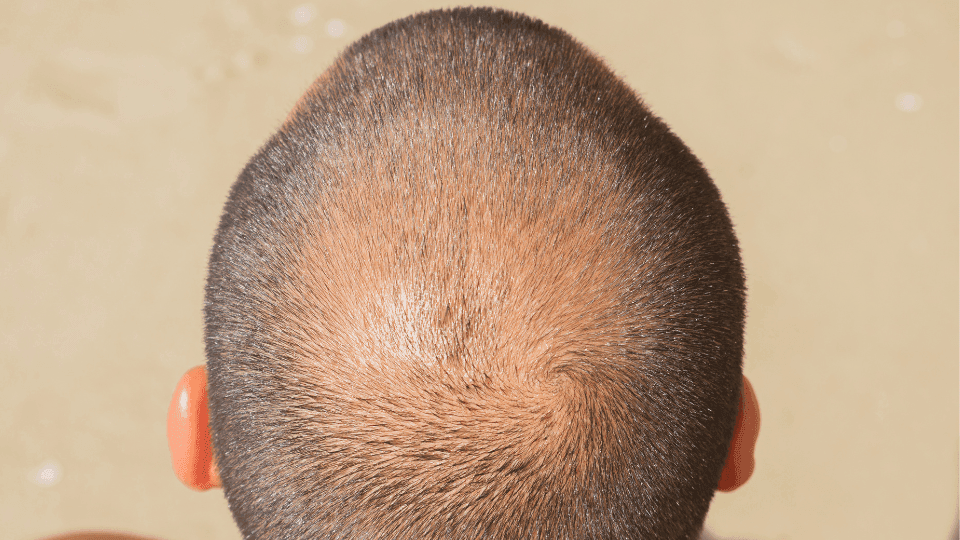 Tanda-Tanda Kebotakan Pola Pria (Male Pattern Baldness) di Usia 20-an