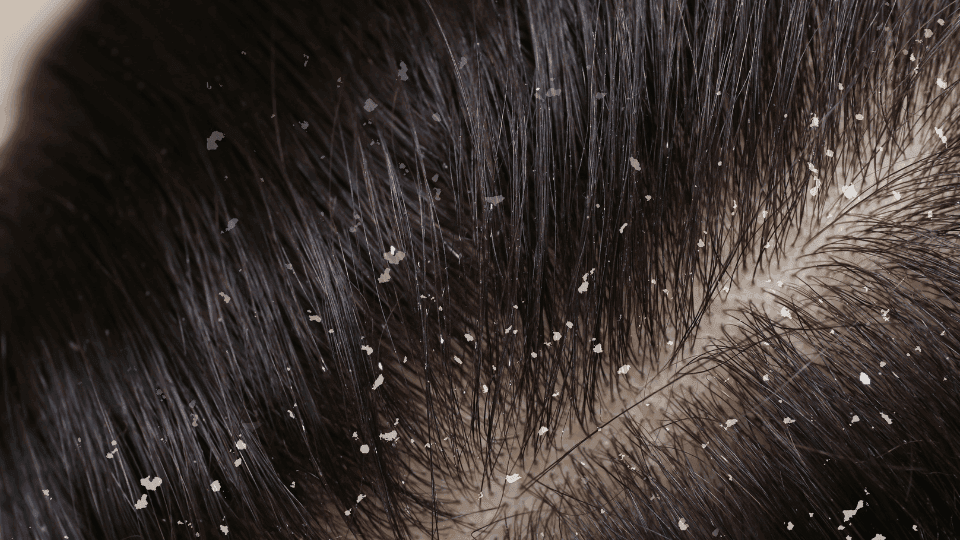 5 Jenis Ketombe dan Cara Mengatasinya dengan Tepat