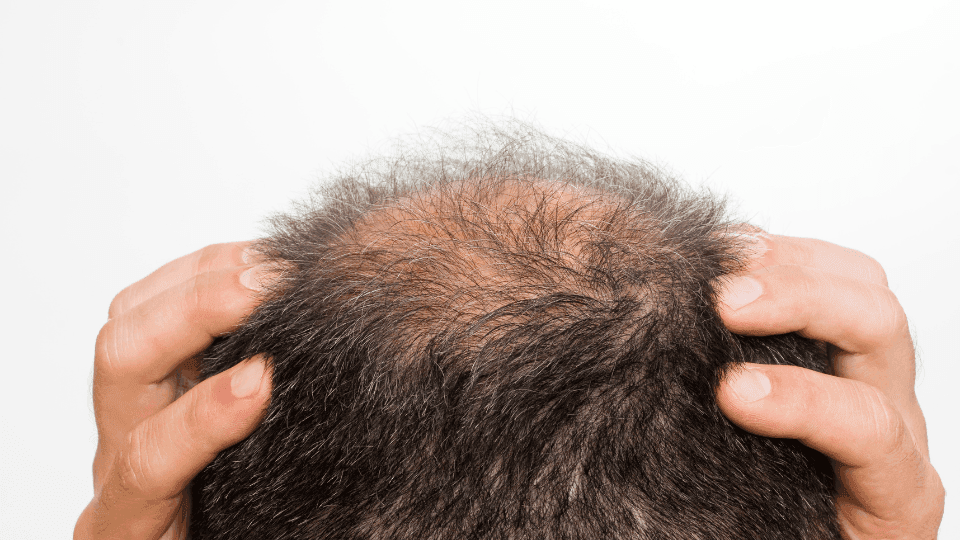 Pola Kebotakan Vertex: Mengapa Rambut di Bagian Ubun-Ubun Menipis Duluan?