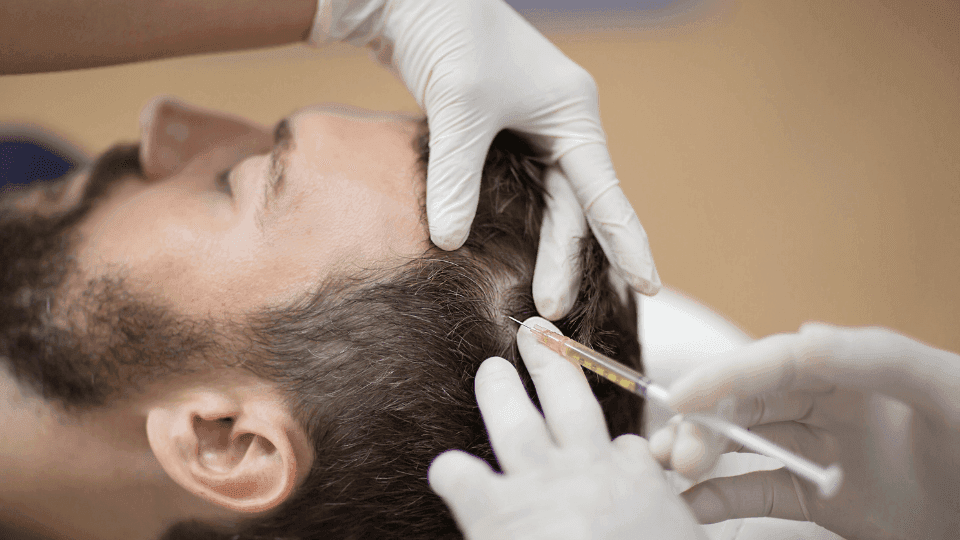 Suntik PRP (Platelet Rich Plasma): Apakah Benar Bisa Menghidupkan Akar Rambut yang Mati?