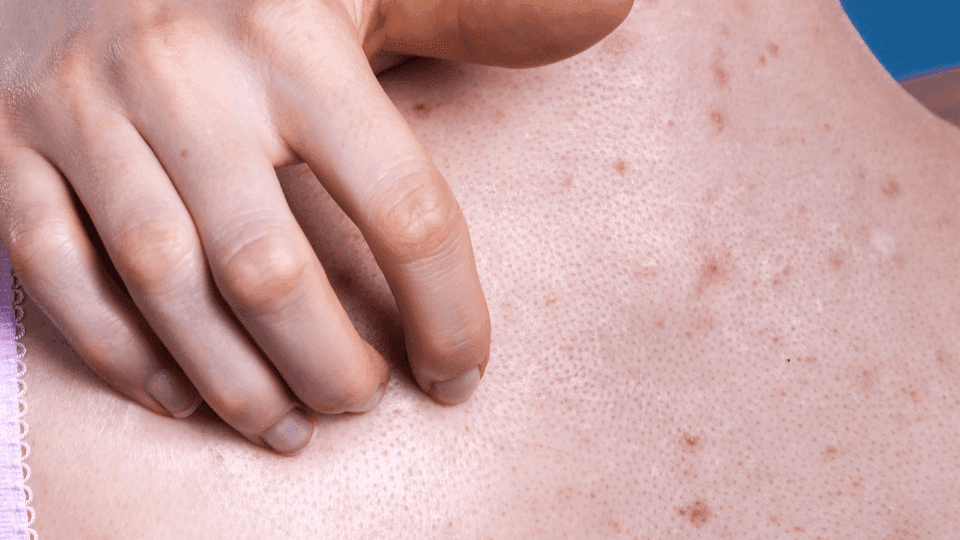 Perawatan Jerawat Tubuh dengan Harga Terjangkau di Klinik Kecantikan Jakarta