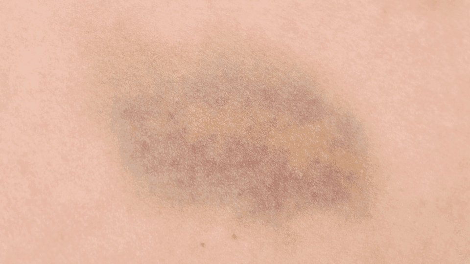 Waspada Memar Tanpa Sebab