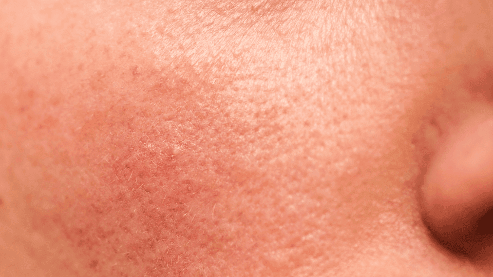 Skin Barrier Rusak Setelah Puasa? Ini Cara Memperbaikinya