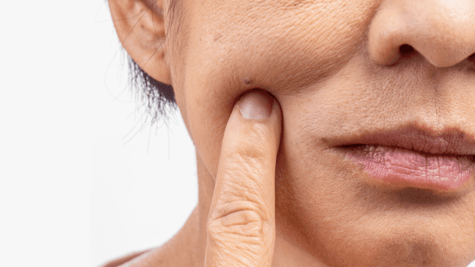 Kulit Dehidrasi? Kenali Ciri-Ciri, Penyebab dan Cara Mengatasinya