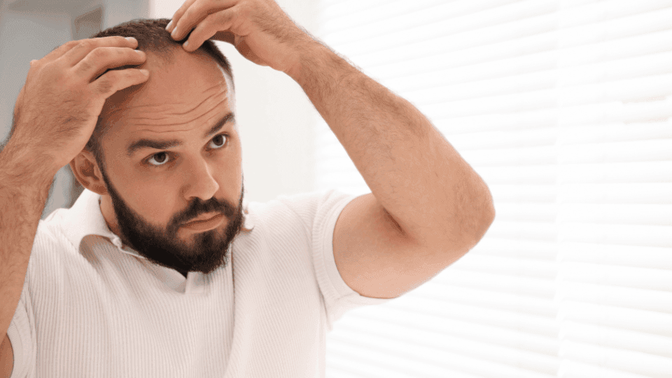 Skala Norwood: Cara Mengetahui Level Kebotakan Rambut Pria