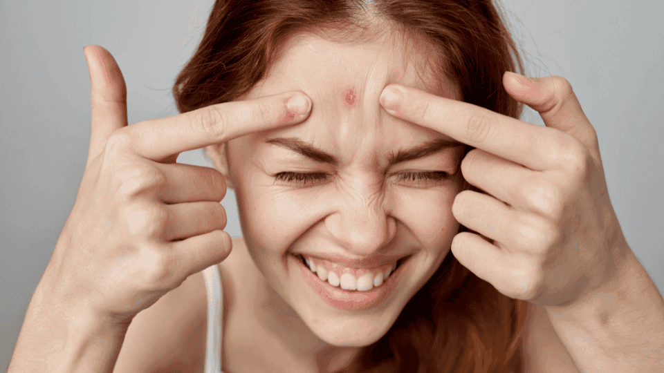 Apakah Jerawat Boleh Dipencet? Ini Cara Mengatasinya dengan Benar