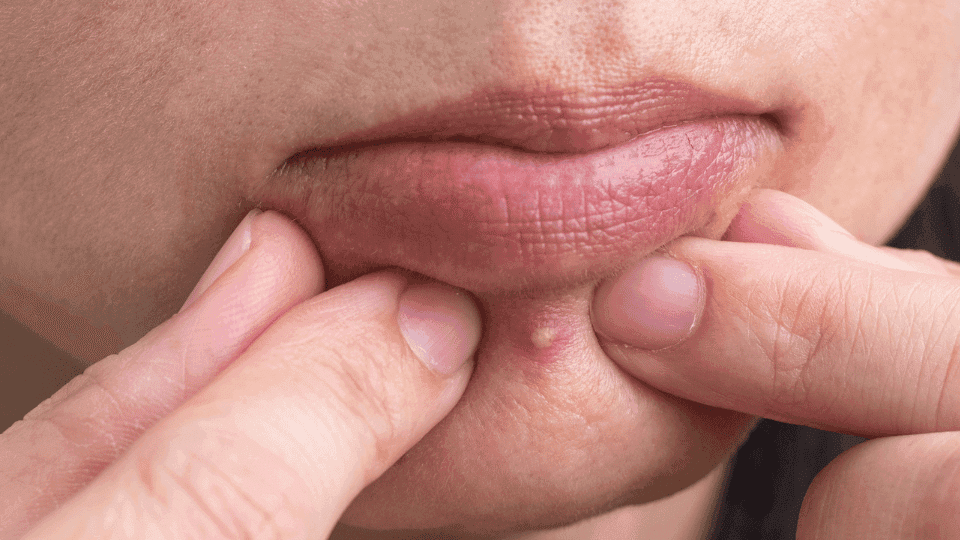 Penyebab Munculnya Jerawat di Rahang dan Cara Mengatasinya