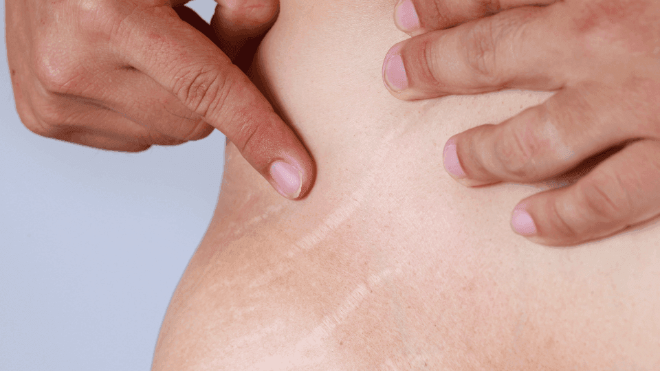 beda selulit dengan stretch mark