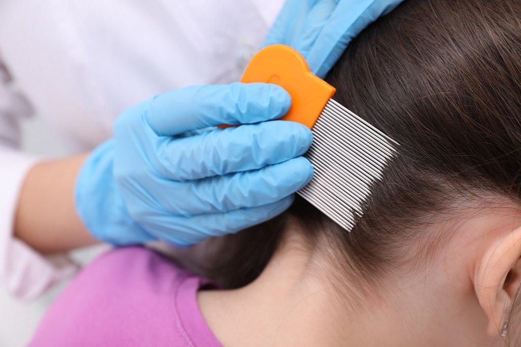 Basmi Kutu Rambut dan Telurnya Diricare
