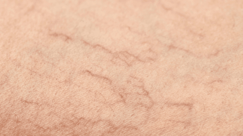 Penyebab Spider Veins di Wajah dan Cara Menghilangkannya