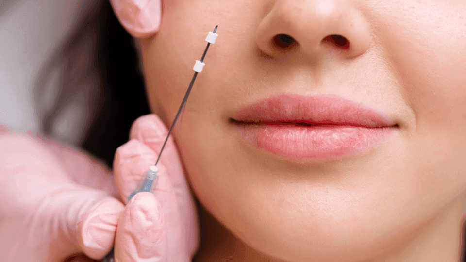 Tanam Benang, Prosedur Kecantikan Bikin Wajah Lebih Kencang