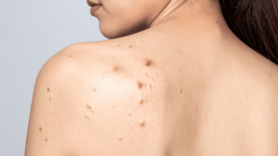 Cara Mengatasi Jerawat Punggung (Bacne) Biar Pede Pakai Baju Lebaran