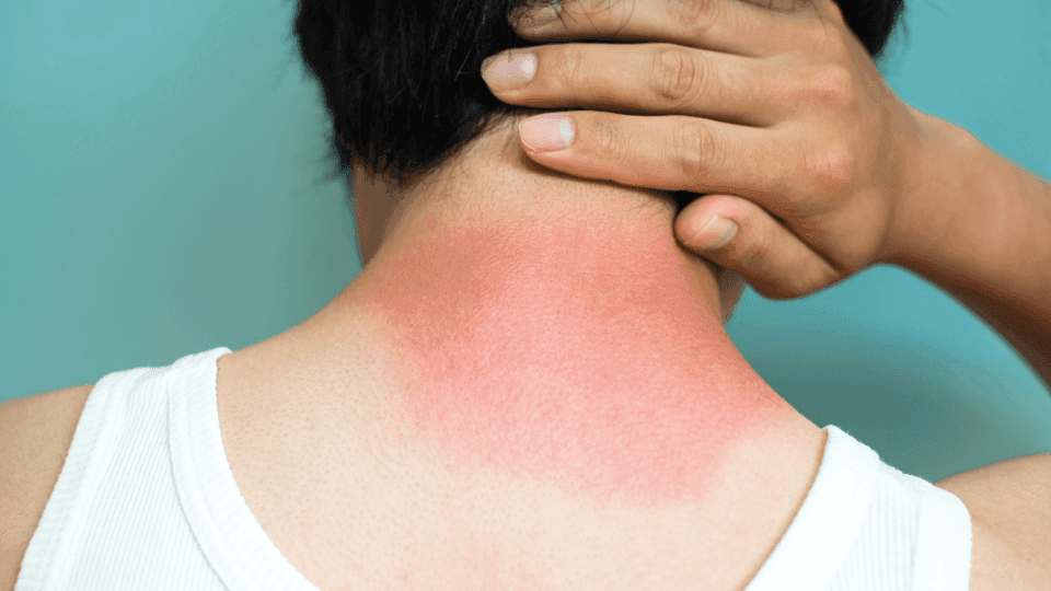 cara mengatasi kulit terbakar karena matahari